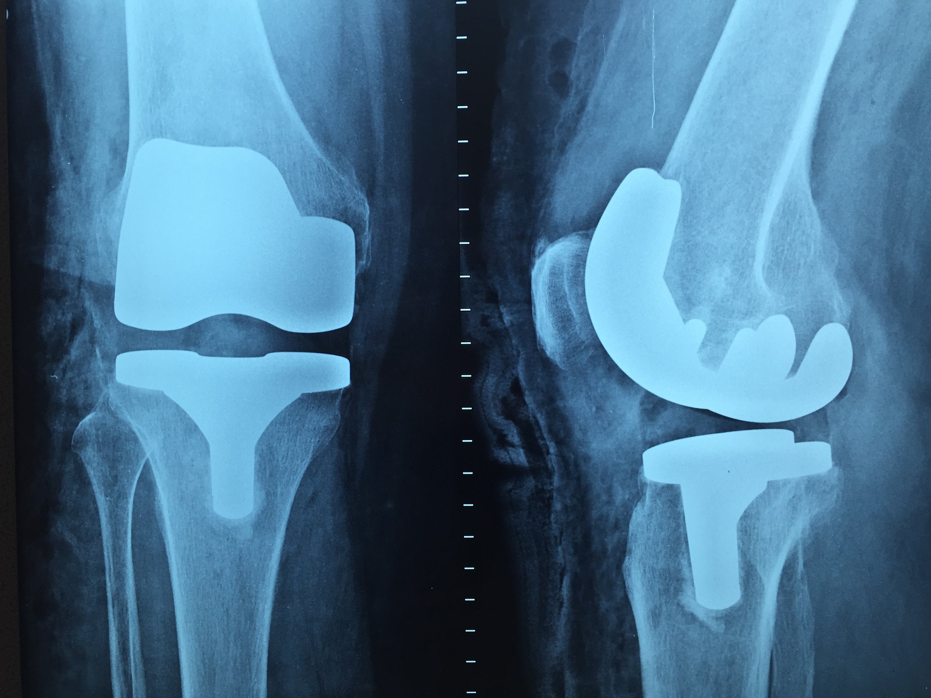 Artios Nanomed, l’implant régénérateur de l’os et du cartilage